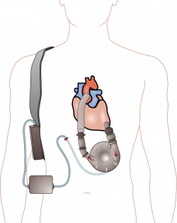 Pierce-Donachy Ventricular Assist Device